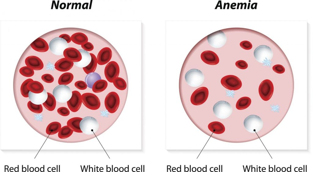 What is anemia?