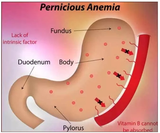 pernicious Anemia